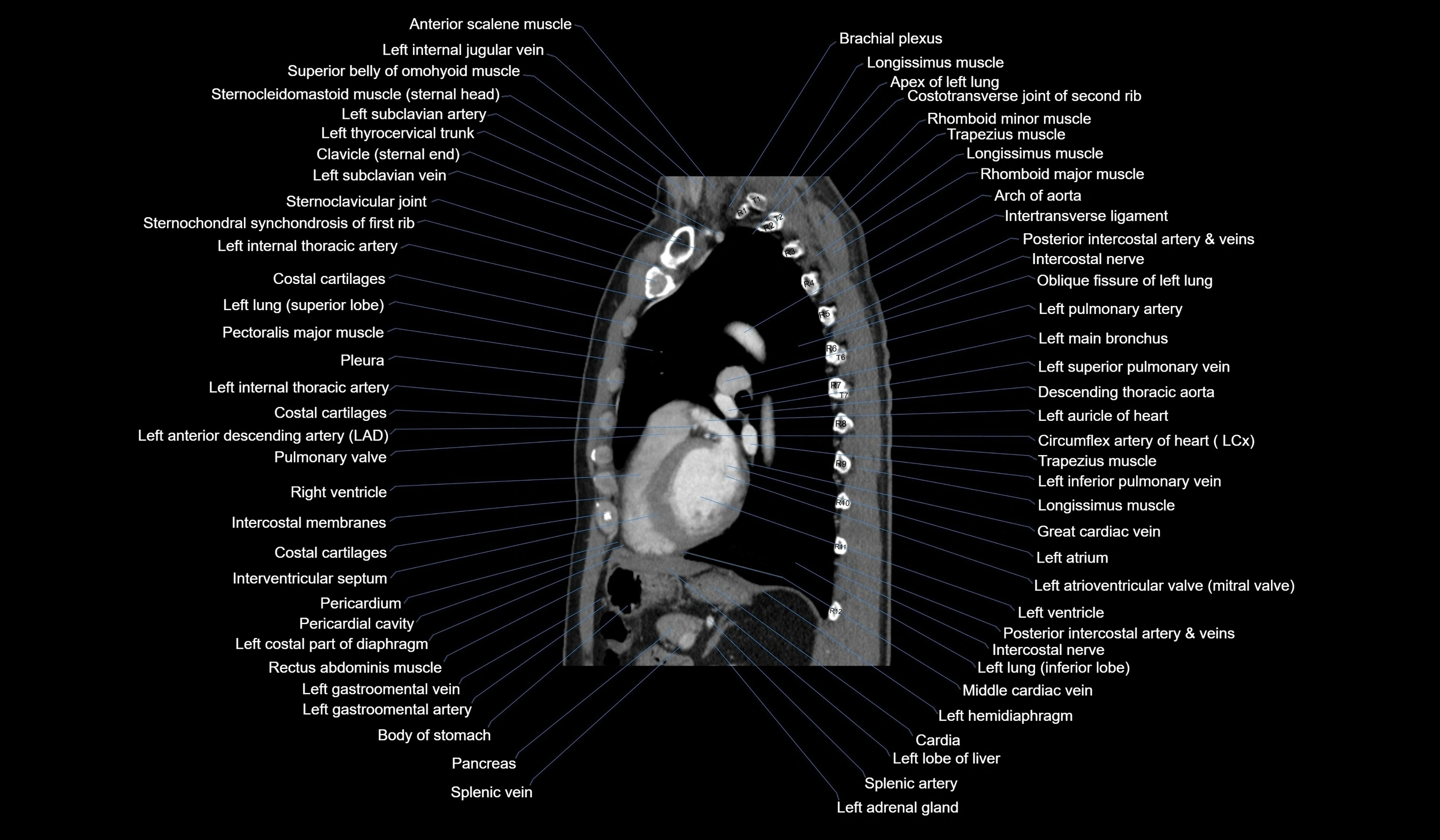 CT chest (thorax) soft tissue window labelled sagittal cross sectional anatomy radiology image-00087.webp